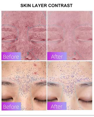 Αγορά Blue Light Acne Treatment Mask with Intelligent Timer – Manufacturer Direct Supply, Appearance Patent Included σε απευθείας σύνδεση κατασκευή